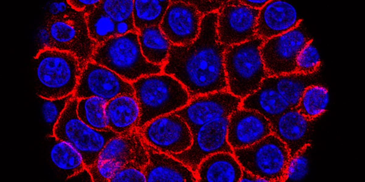 Breakthrough Drug Doubles Survival for Advanced Pancreatic Cancer Patients