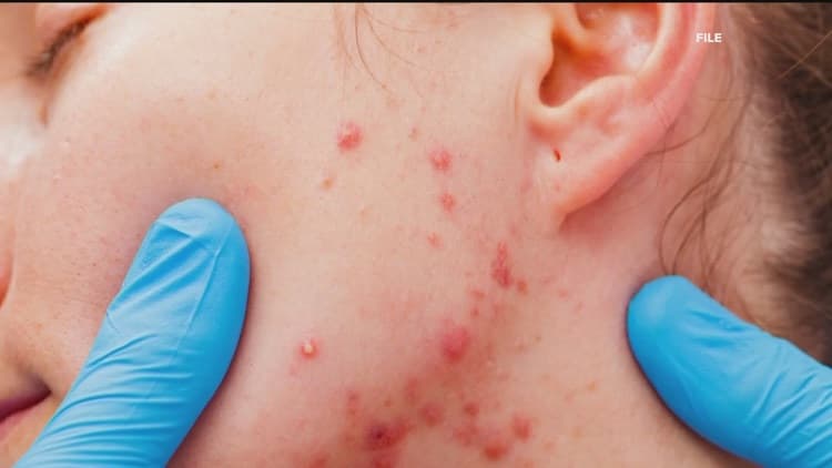 Georgia Reports 3 Measles Cases; Local Health Officials Advise Vaccination
